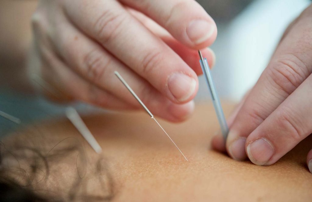 Acupuncture massage pain treatment